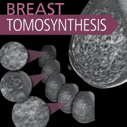 Breast Tomosynthesis -1E