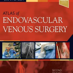 Atlas of Endovascular Venous Surgery: Expert Consult - Online and Print - 2E