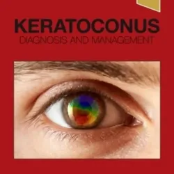 Keratoconus: Diagnosis and Management - 1E