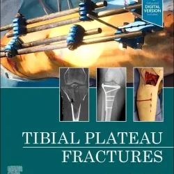 Tibial Plateau Fractures-1E