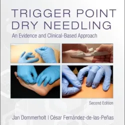 Trigger Point Dry Needling -2E