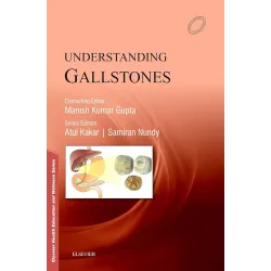 Understanding Gallistones - 1E