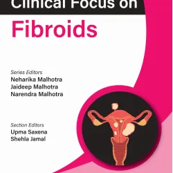 Clinical Focus On Fibroids