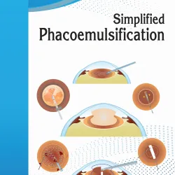 Simplified Phacoemulsification