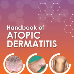 Handbook Of Atopic Dermatitis