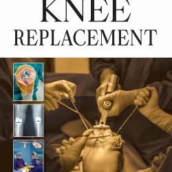 Knee Replacement