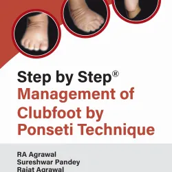 Step By Step Management Of Clubfoot By Ponseti Technique